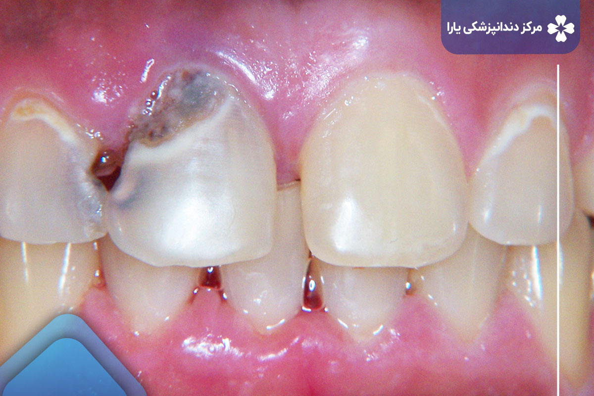 علت پوسیدگی دندان جلو