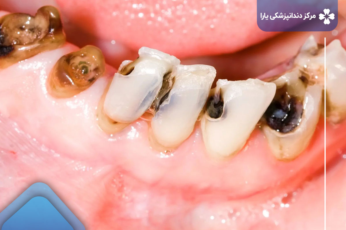 درک پوسیدگی دندان