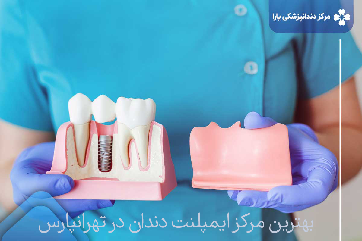 بهترین مرکز ایمپلنت دندان در تهرانپارس 