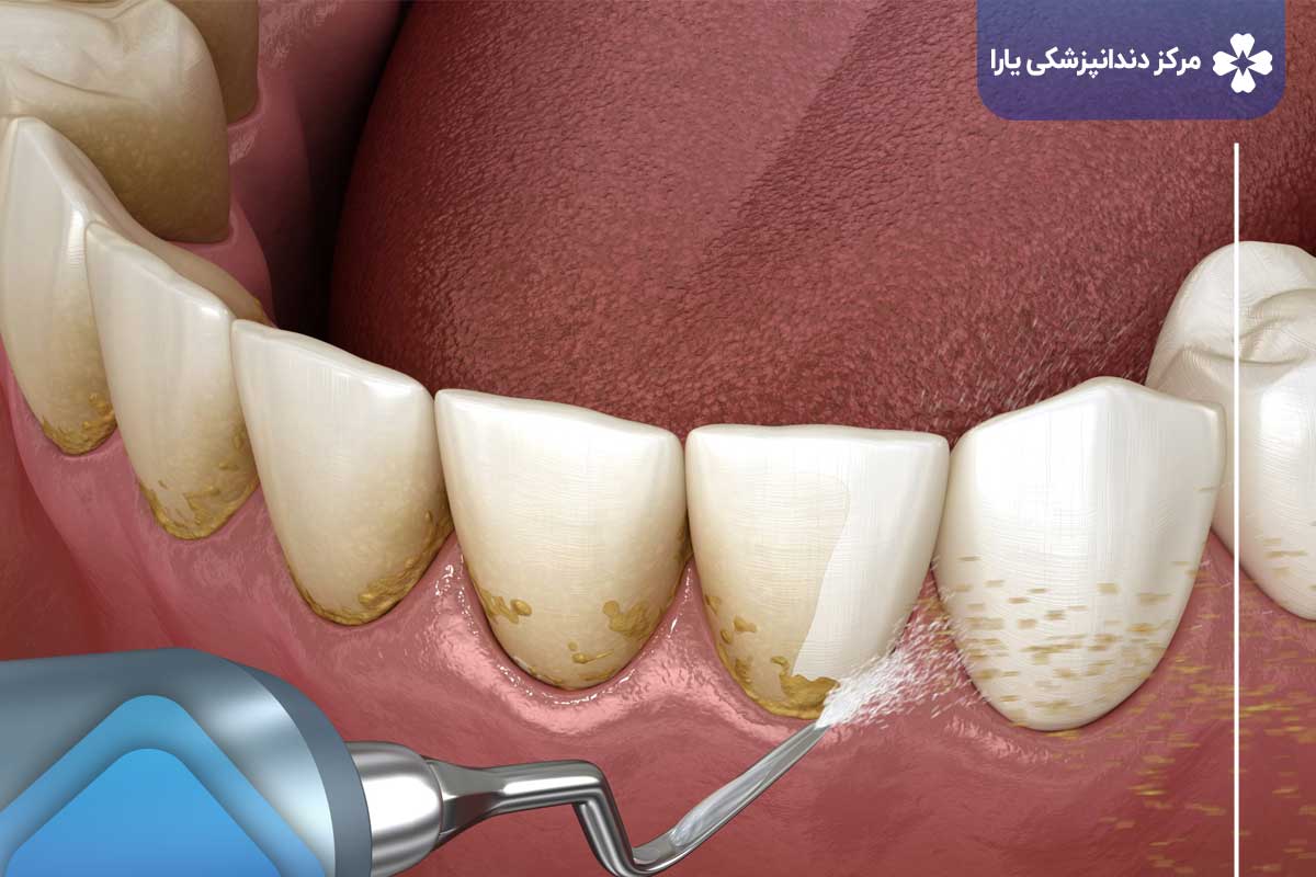 انواع جرمگیری دندان