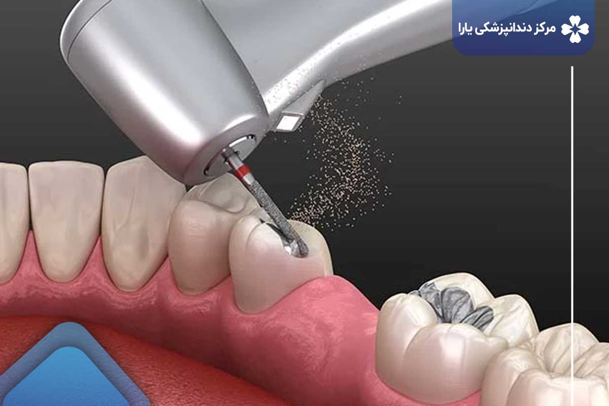 تعویض پر کننده دندان