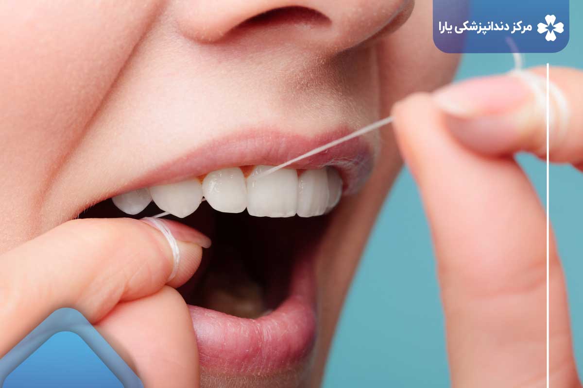 پیشگیری از پوسیدگی دندان جلو