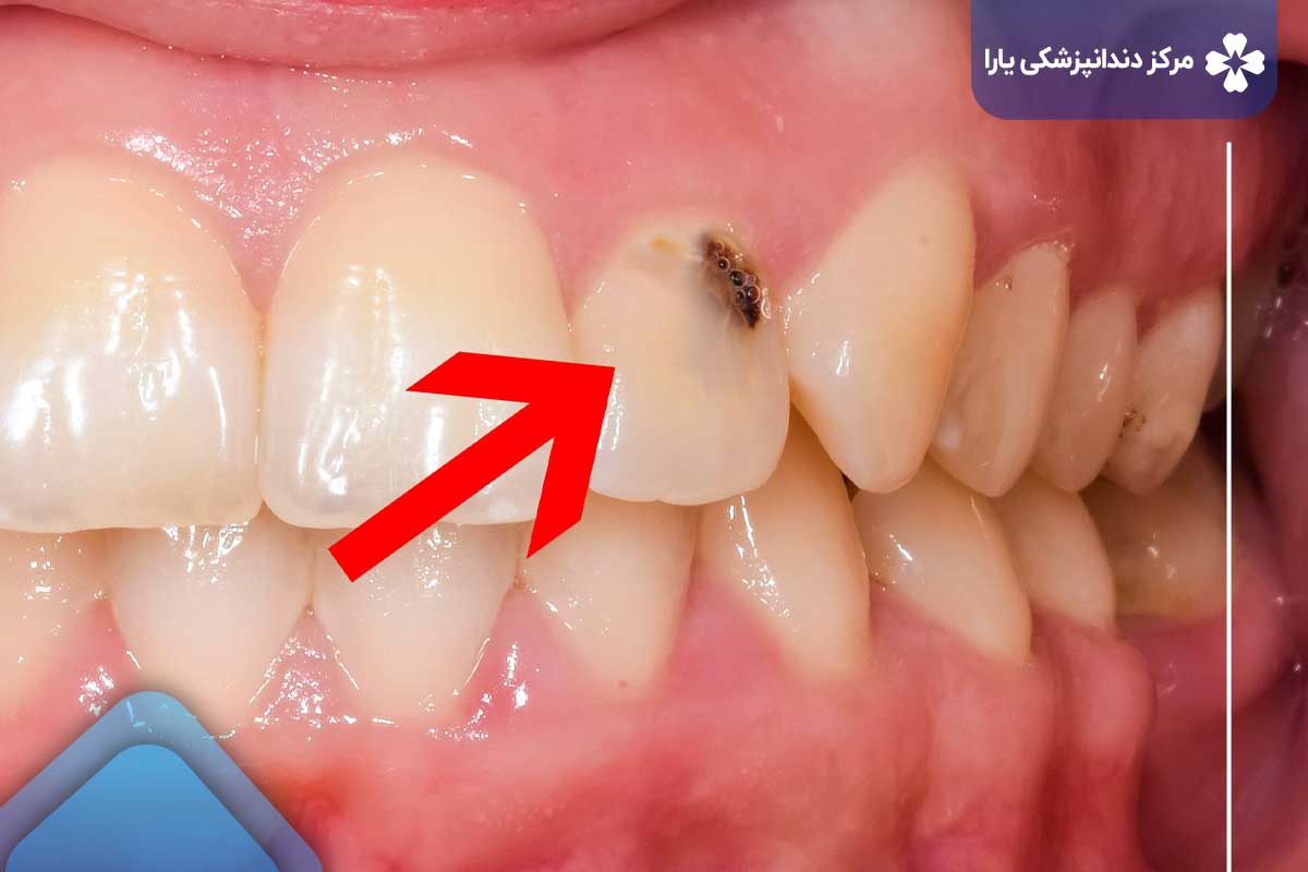 علت پوسیدگی دندان جلو