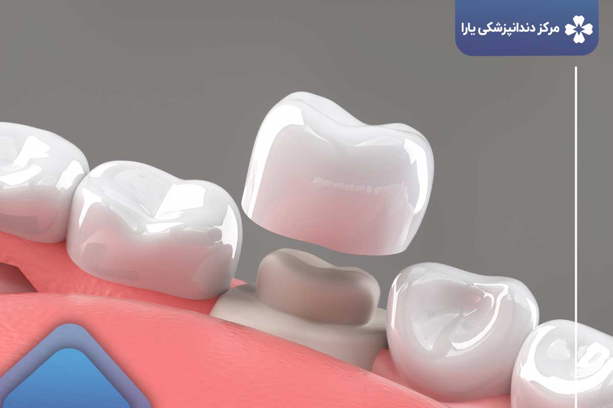 روکش دندان بعد از عصب کشی دندان