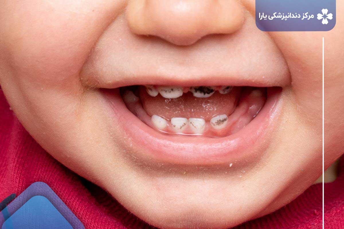 سیاه شدن دندان کودکان