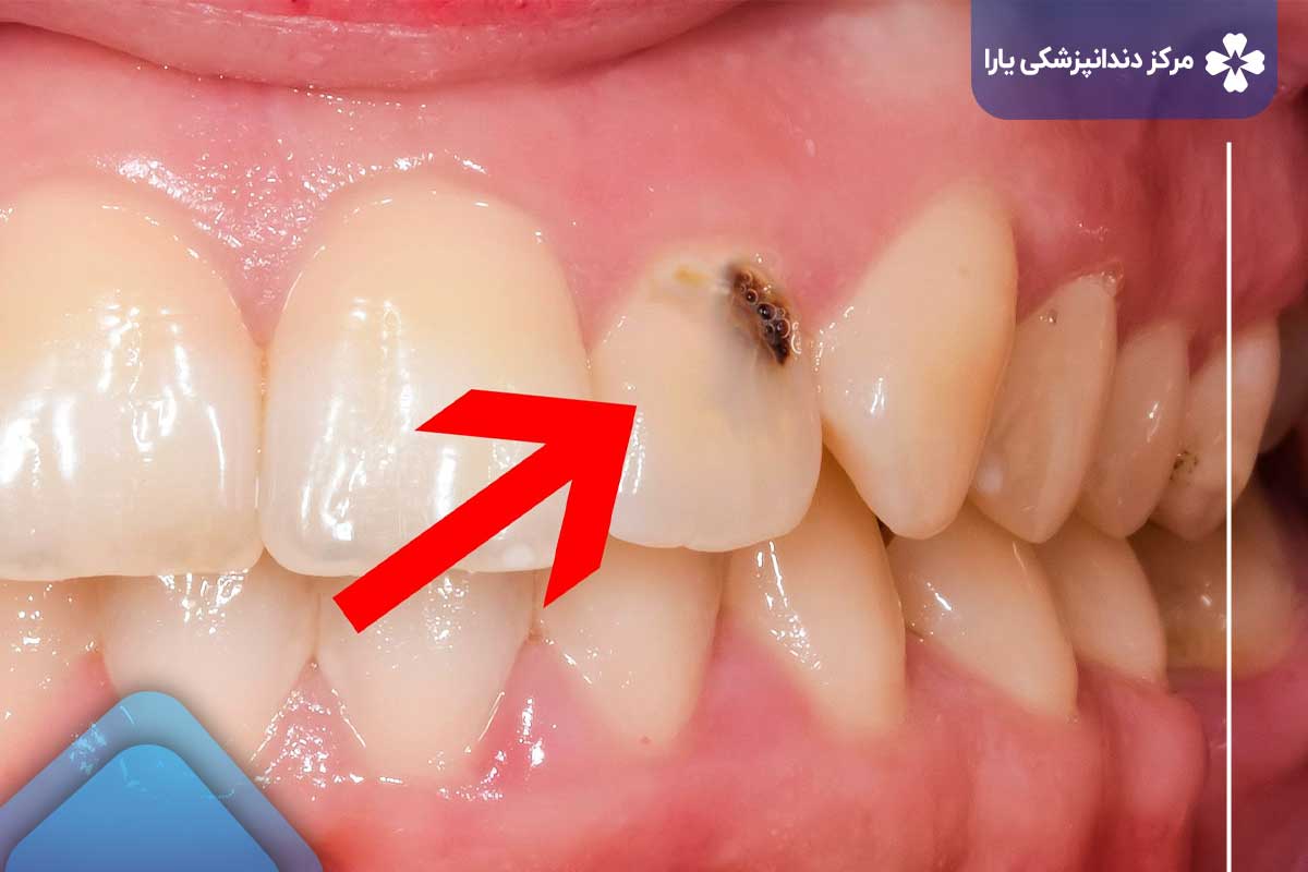 سیاه شدن دندان در اثر پوسیدگی