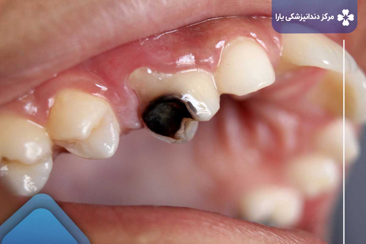 مدیریت و پیشگیری از سیاه شدن دندان