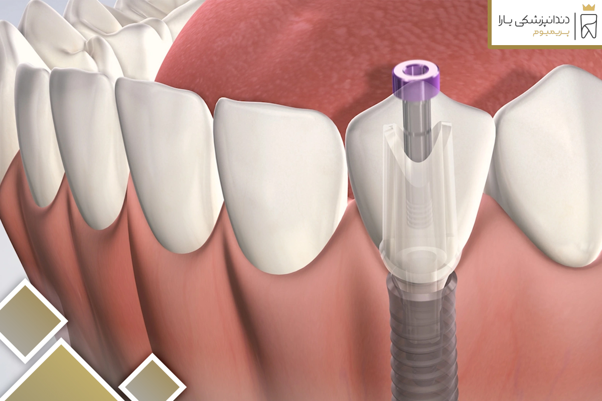 مزیت های انجام ایمپلنت دندان