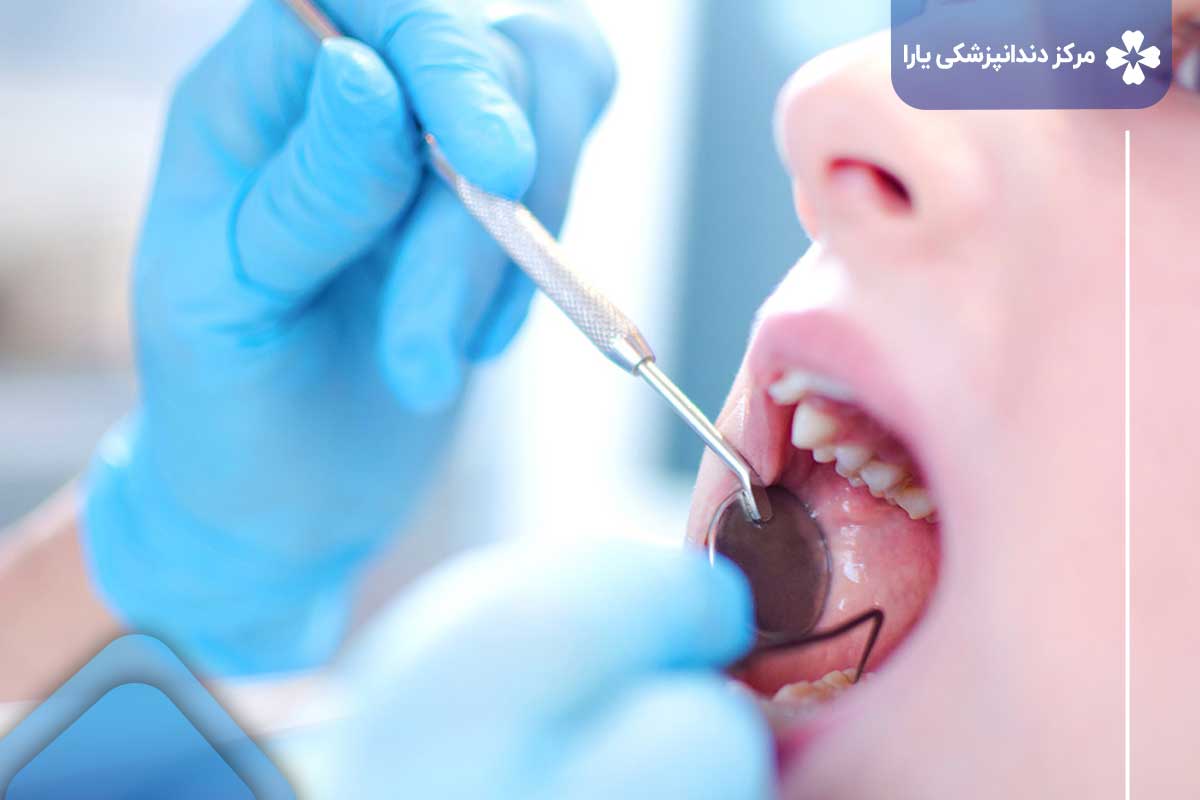 سریع ‌ترین درمان سیاه شدن دندان
