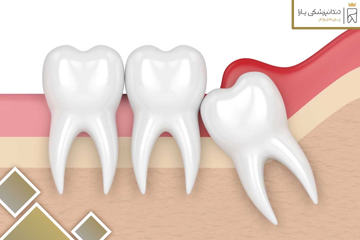علل بروز دندان عقل زودرس