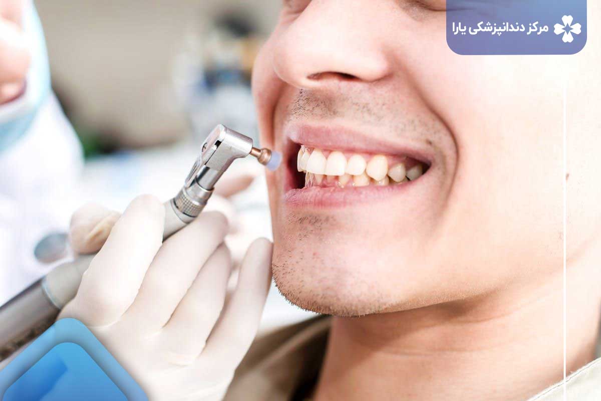روند درمان پروفیلاکسی دندان 