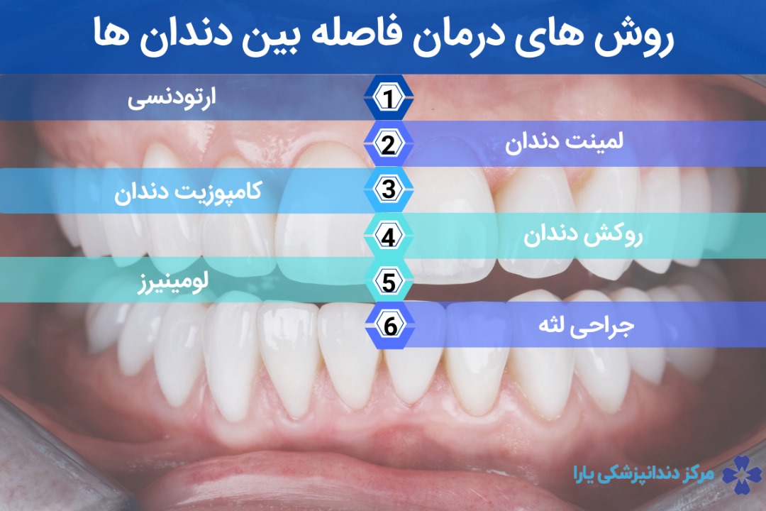  روش های درمان‌ها برای فاصله بین دندان‌ها