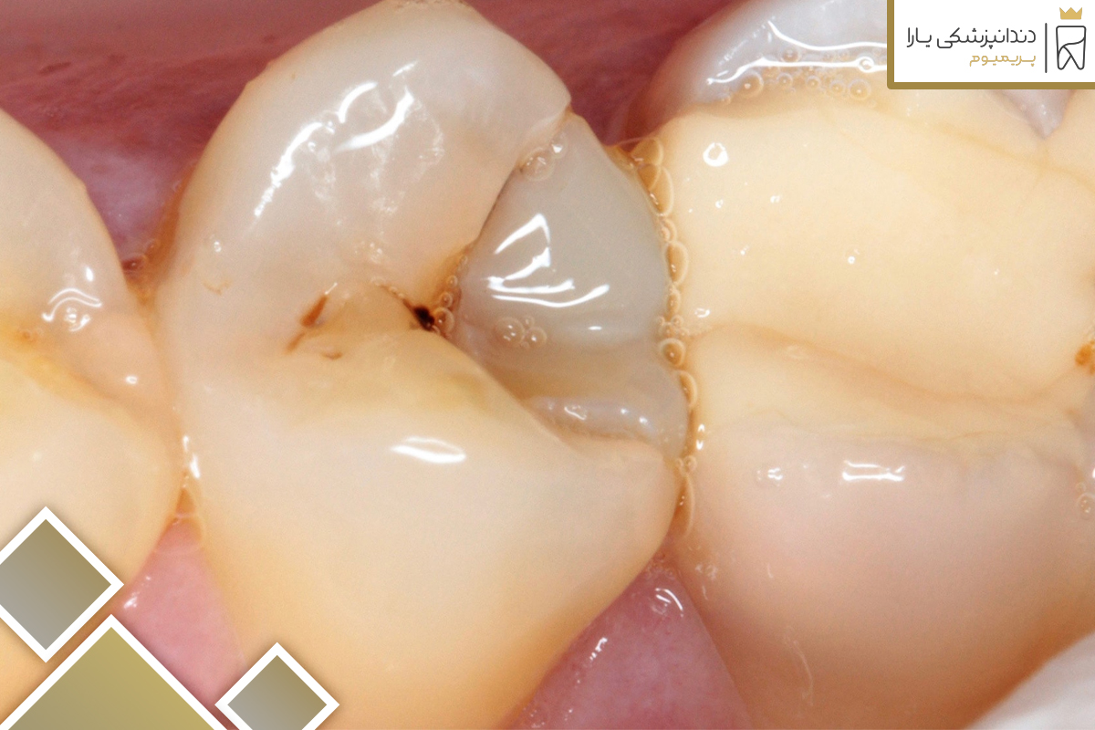 روش تشخیص پوسیدگی دندان پس از کامپوزیت 