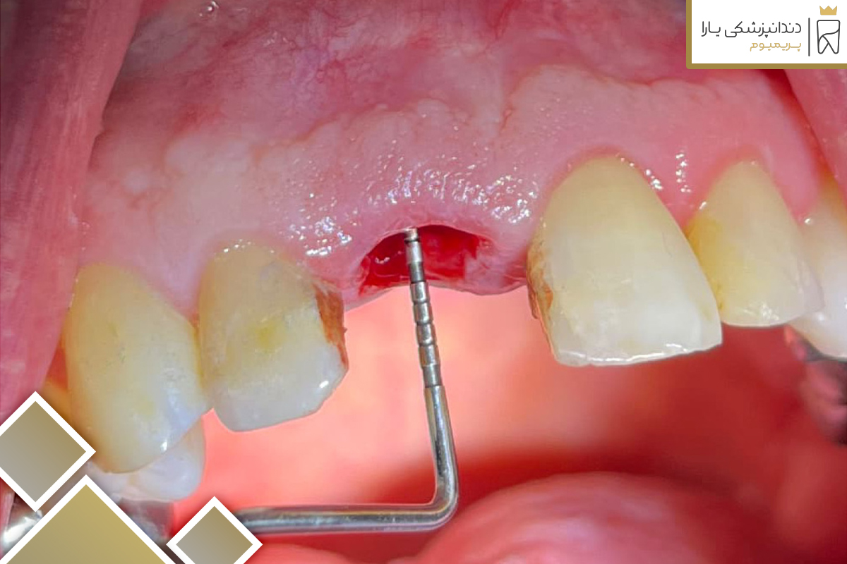 سوراخ شدن لثه بعد از کشیدن دندان