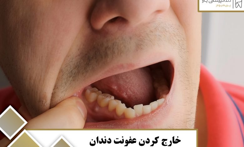 خارج کردن عفونت دندان