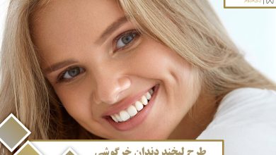 طرح لبخند دندان خرگوشی